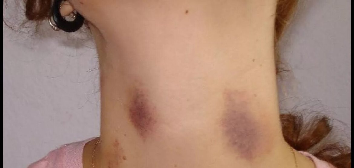 Полиция Канска расследует жестокое избиение женщины её сожителем