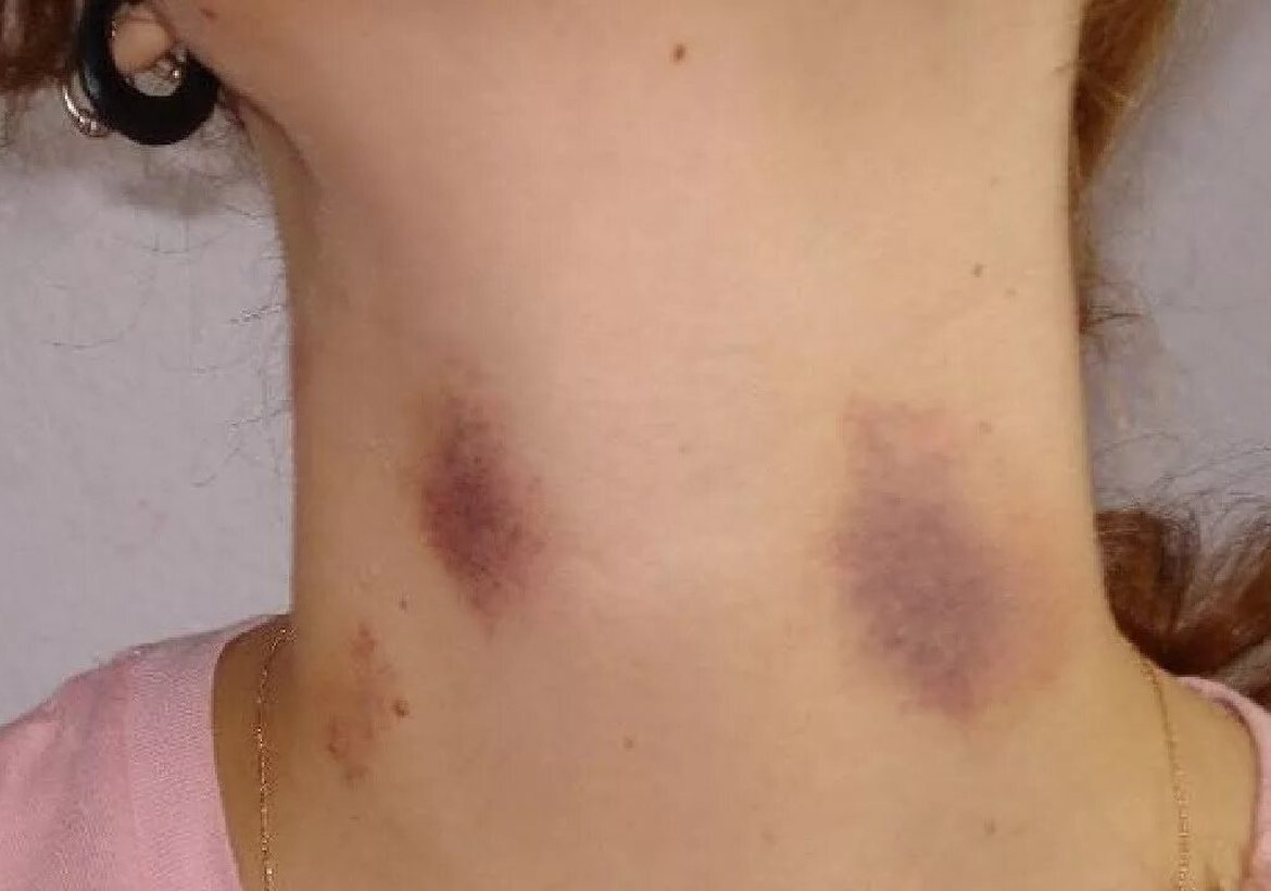 Полиция Канска расследует жестокое избиение женщины её сожителем