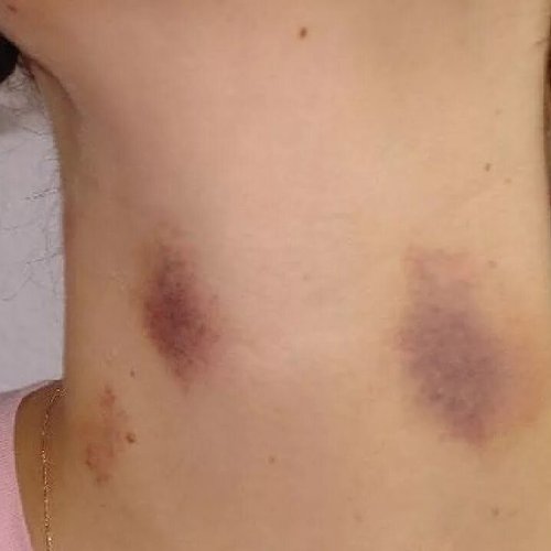 В Канске мужчина жестоко избил свою гражданскую супругу